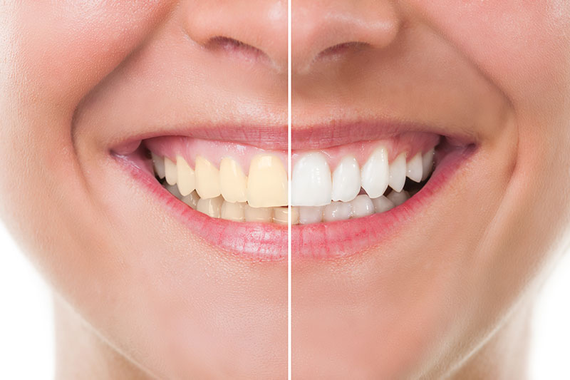 Teeth Whitening in Oklahoma City